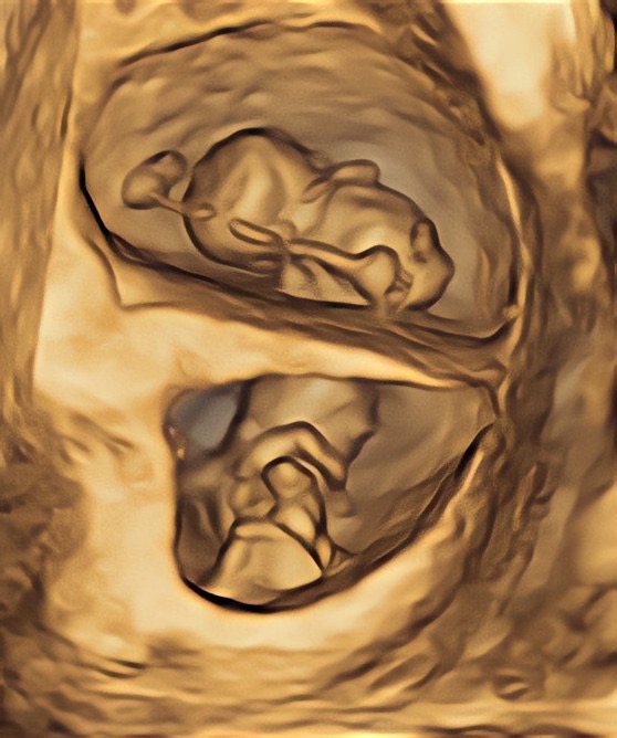 Afbeelding bij LIP opstelling alleengeboren tweeling